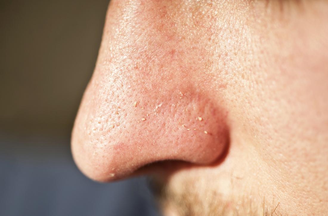 How to get rid of a zit on your nose? BioTech